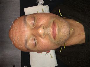 Cosmetische Acupunctuur 